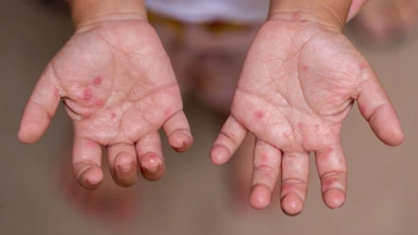 HFM Disease on hands